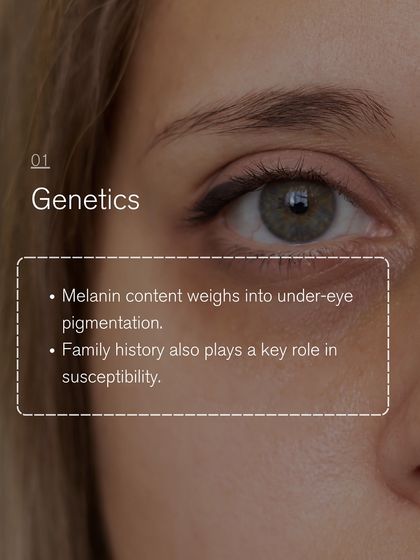 Genetics and family history play a key role in susceptibility to under-eye pigmentation due to melanin content. Understanding this helps in creating an effective treatment plan.