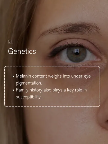 Genetics and family history play a key role in susceptibility to under-eye pigmentation due to melanin content. Understanding this helps in creating an effective treatment plan.