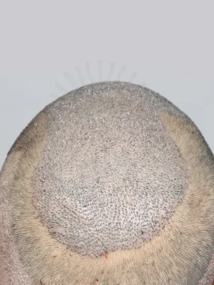 The result of implanting 5900 grafts for a Diffuse Grade 6 patient, showing the density and coverage achieved.