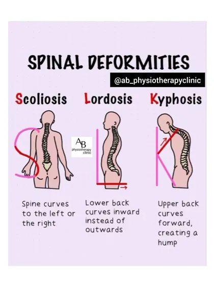 Spinal deformities like Scoliosis, Lordosis, and Kyphosis require specialized management. This visual explains the difference between these conditions, all of which I treat with tailored exercise programs and manual therapy to improve alignment and reduce discomfort.