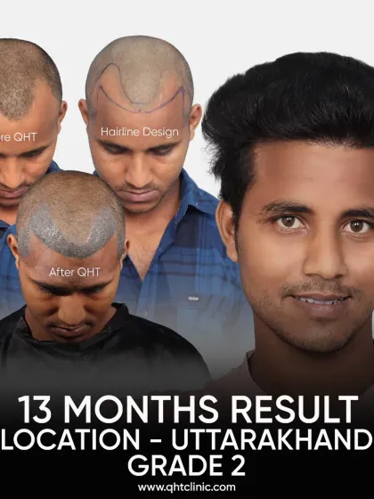 A 13-month result for a Grade 2 patient from Uttarakhand. We used 3050 grafts to create a fuller, natural hairline.