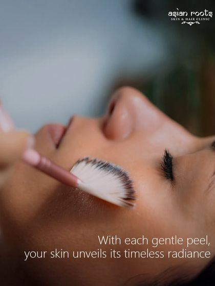 A chemical peel is a classic and effective way to unveil timeless radiance. This close-up shot shows the gentle application of a peel, which works to exfoliate the outer layer of skin, revealing a fresher, newer layer beneath.
