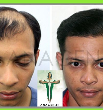 A before and after photo showcasing the best of our Instant BioFUE technique, delivering high density results and an excellent, natural hairline.