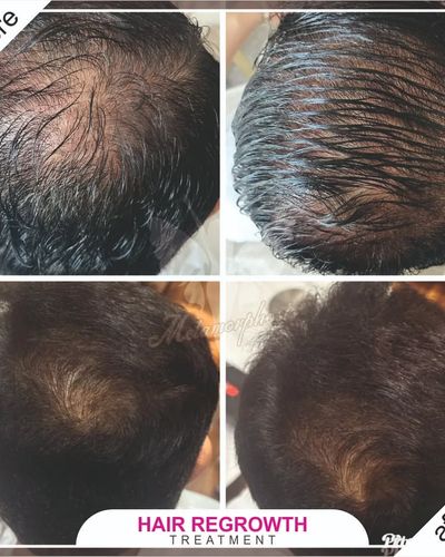Hair Loss & Regrowth Treatment