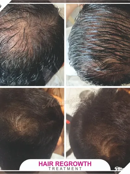 A comprehensive look at a male hair regrowth journey. These four photos document the progress from multiple angles, highlighting the return of both density and a stronger hairline.