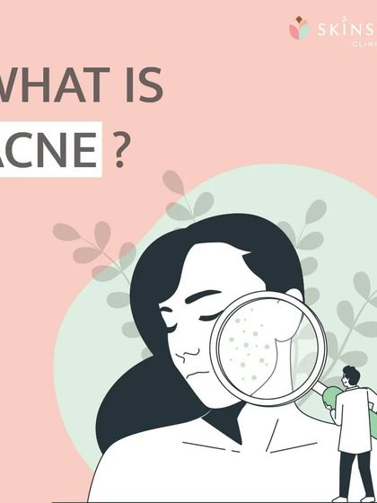 A simple infographic explaining what acne is. It illustrates how pores can become blocked by oil, bacteria, and dead skin cells, leading to different types of blemishes.