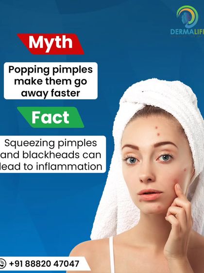 A common myth is that popping pimples helps them heal faster. The fact is, squeezing can cause inflammation and lead to permanent scarring. For proper acne management, it is always best to consult a dermatologist.