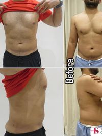 Body Contouring Surgery