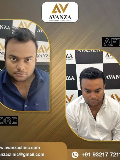 From thin to thick, this transformation showcases the effectiveness of our hair transplant procedure in restoring volume and confidence.