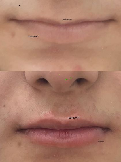 Another example of a subtle yet effective lip enhancement. We added soft volume and definition to create a beautifully natural look.