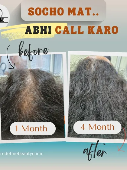 You don't always need surgery for great results. This is a four month transformation using our non-surgical GFC hair treatment. We used the power of his own growth factors to reduce hair fall and significantly improve hair density and thickness, especially in the crown area.