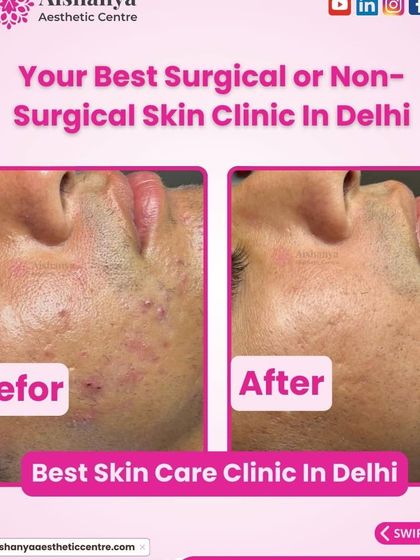 This image shows the improvement of both active acne and the resulting textural issues. Our goal is always twofold: to stop new pimples from forming and to repair the damage left by old ones.