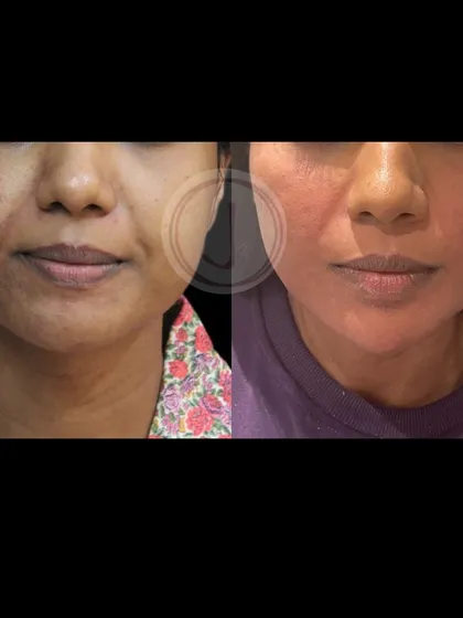 A front-view comparison after a facial contouring procedure. The patient's face appears more rested and defined, with a visible reduction in sagging around the mouth and jaw.