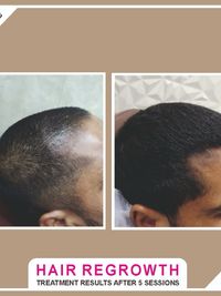 Hair Loss & Regrowth Treatment