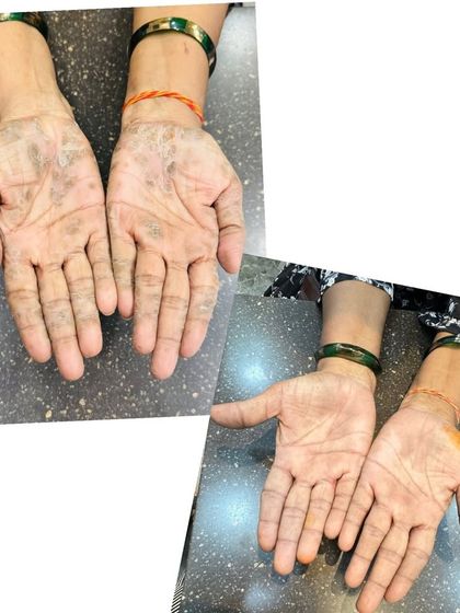 Restoring Comfort to Hands with Keratoderma. Thickened, peeling skin on the palms can be debilitating. This image shows the healing process and restoration of smoother skin on the hands after targeted therapy.