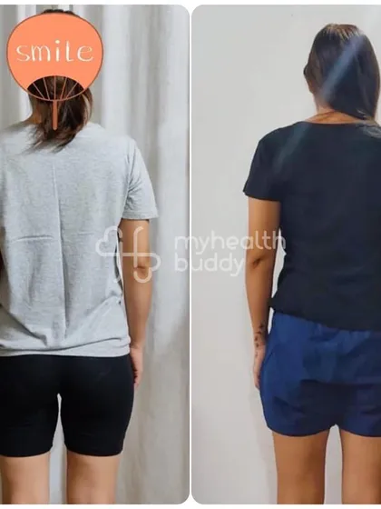 The back view of the same client's DR transformation, showing a more toned and defined back.