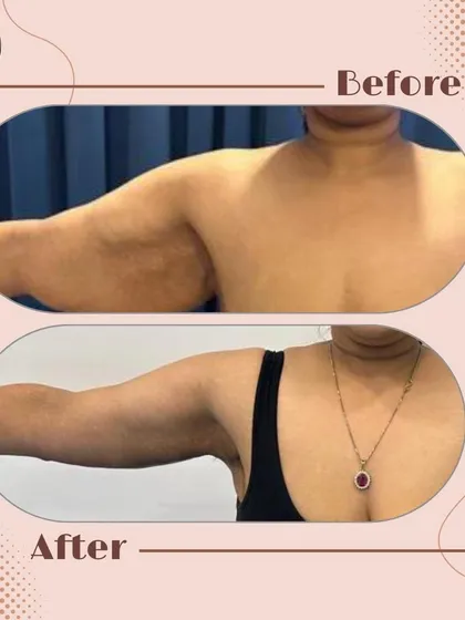 This before and after image shows the result of a brachioplasty, or arm lift. This procedure is designed to remove excess, sagging skin from the upper arms, creating a slimmer and more toned appearance.