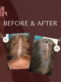 Hair Restoration Therapy