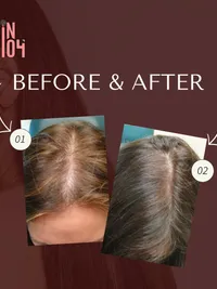 Hair Restoration Therapy