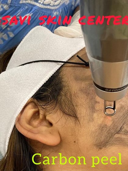 Sree Vasavi - Anti-Aging & Skin Tightening Advanced Skin Rejuvenation: Lasers & Peels photo 5