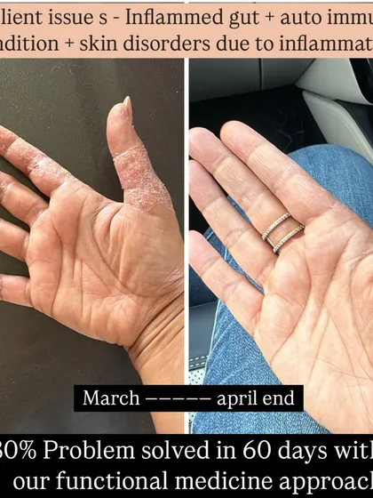My functional medicine approach goes beyond weight. This client was struggling with an inflamed gut and an autoimmune skin condition. In just 60 days, by focusing on an anti-inflammatory diet, we solved 80% of the issue.