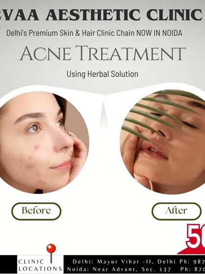 Before and after results for our acne treatment using a herbal solution, with a 50% off offer.