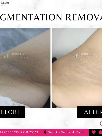 Dark underarms are a common concern, and this before-and-after shows the significant lightening we can achieve. Using targeted Q-Switch laser therapy, I can safely break down the pigmentation, resulting in clearer, more even-toned skin.