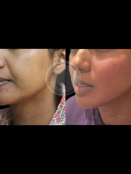 Another angle showcasing the results of our facial contouring work. The treatment helped to soften shadows and create a more harmonious profile by carefully adding volume where it was needed.