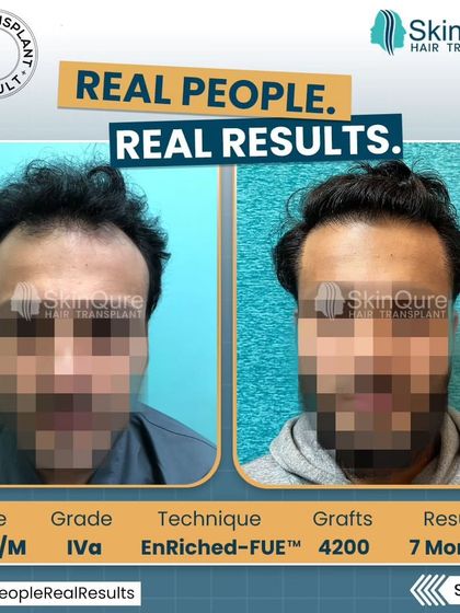 A frontal view of the 23-year-old patient's transformation. The before and after comparison clearly shows the life-changing result, restoring a full head of hair and a youthful appearance.
