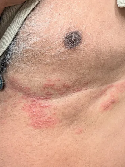 This is a clinical presentation of a shingles, or herpes zoster, outbreak. The painful, blistering rash follows a nerve path and can lead to debilitating nerve pain that lasts for months, even after the skin has healed. This is what we aim to prevent with the shingles vaccine available at my clinic.