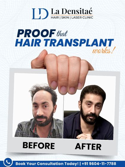 Here is more proof that hair transplants work. This incredible before-and-after transformation brought back not just hair, but a renewed sense of confidence. With the right care and expertise, these are the results you can expect.