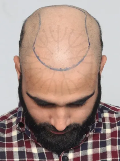 This shows the crucial first step: hairline design. We mark the area precisely to ensure the final result perfectly frames the face.