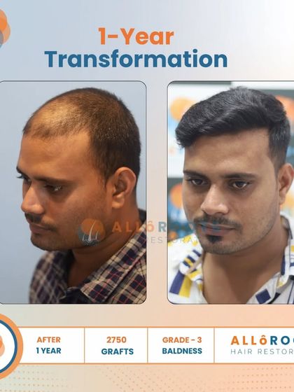 This one-year transformation for a Grade 3 baldness case was achieved with 2750 grafts. The series of photos demonstrates the significant improvement in density and hairline from every angle.