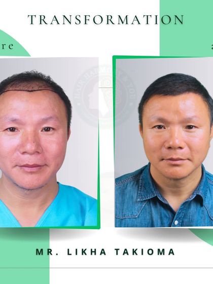 Mr. Likha Takioma's transformation is a perfect example of a successful hair restoration. The 'after' photo shows a natural, dense hairline that has completely changed his appearance and brought back his confidence.