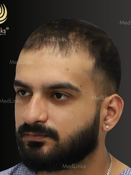 This patient came to us with thinning hair that had started to affect his appearance. The 'before' stage is critical for us to assess and plan a personalized hair restoration journey.