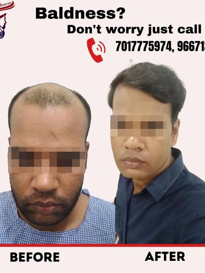 Don't let baldness define your personality. This before and after shows a dramatic change, restoring this client's hair and giving him a completely refreshed look.