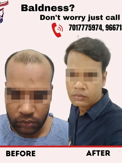 Don't let baldness define your personality. This before and after shows a dramatic change, restoring this client's hair and giving him a completely refreshed look.