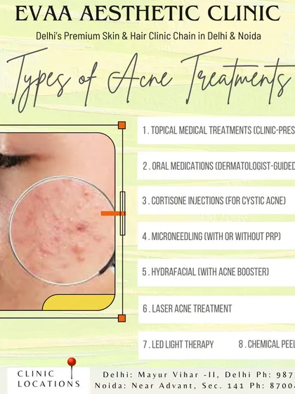 A detailed guide to the types of clinical acne treatments we offer. This includes topical medications, laser acne treatment, chemical peels, and HydraFacial with acne boosters.