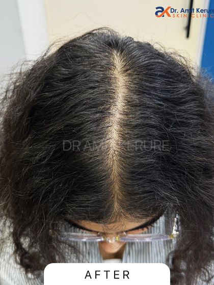 This is the 'after' photo of the same patient, showing a remarkable increase in density and a much narrower partition. This was achieved through a personalized treatment plan involving GFC and PRP therapy.