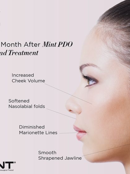 This graphic shows the results you can expect one month after a MINT PDO thread treatment. It highlights benefits like increased cheek volume, softened nasolabial folds, and a smoother, sharpened jawline.