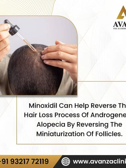 For certain types of hair loss like androgenetic alopecia, we may recommend Minoxidil. This topical solution works by helping to reverse the miniaturization of follicles, allowing them to grow stronger and thicker.