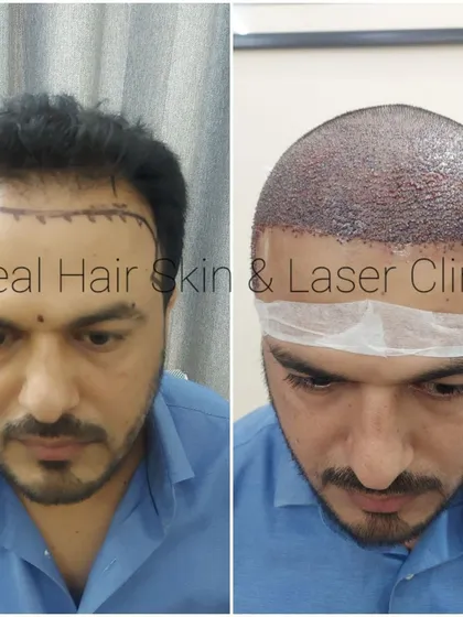 This image shows the patient before the procedure with the planned hairline and immediately after, with the recipient area densely packed with new follicles.