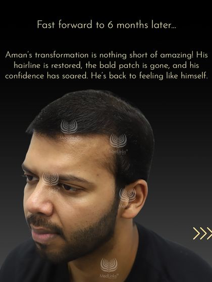 Six months later, Aman's hairline is restored, the bald patch is gone, and his confidence has soared.