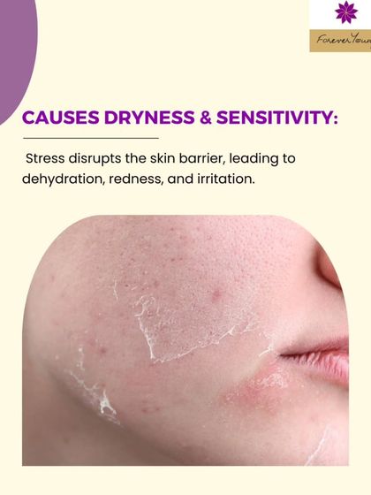 A compromised skin barrier is another side effect of chronic stress. This disruption leads to transepidermal water loss, causing dehydration, redness, and increased sensitivity.