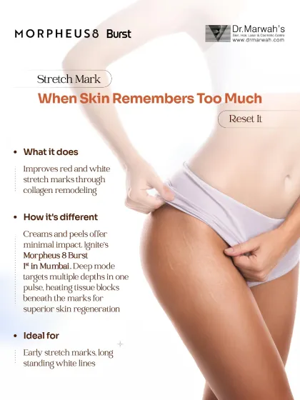 Stretch marks occur when the skin's structure is compromised, and topical creams often provide minimal improvement. I use Morpheus8 Burst, a deep-mode radiofrequency technology, to remodel collagen and improve the texture of both red and white stretch marks by targeting multiple skin depths in a single pulse.