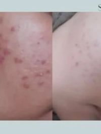 Skin Correction & Rejuvenation