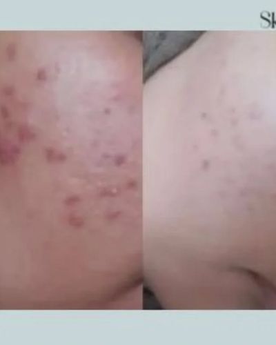 Skin Correction & Rejuvenation