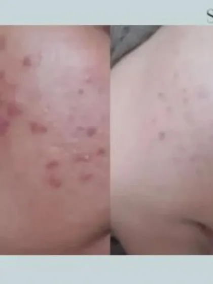 This transformation showcases the reduction of both active acne and post-inflammatory marks. My approach combines multiple technologies to not only clear breakouts but also to repair the skin's surface for a smoother finish.