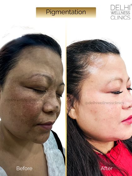 This side-angle shot displays the successful fading of pigmentation on the cheek, resulting in smoother and more evenly toned skin.