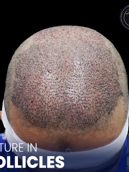 This is where science meets style. A detailed view of newly implanted hair follicles, showcasing the meticulous process of high-density hair restoration.